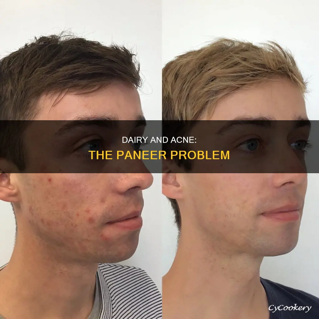 can paneer cause acne