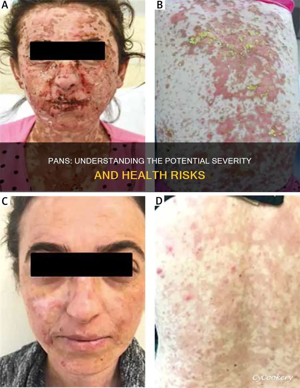 can pans develop into a more severe illness