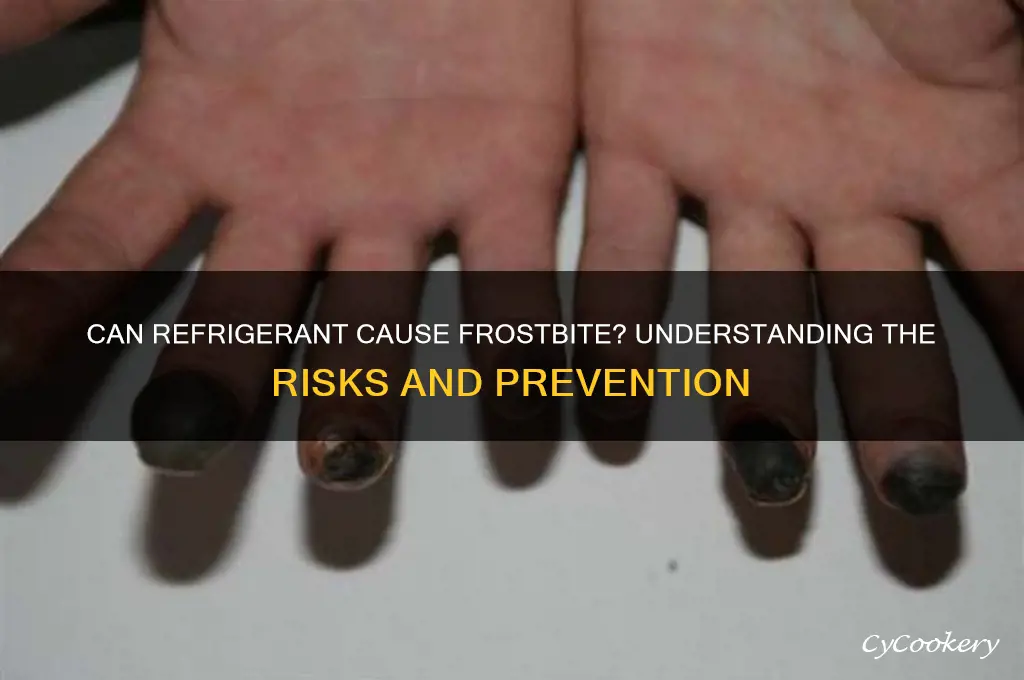 can refrigerant cause frostbite