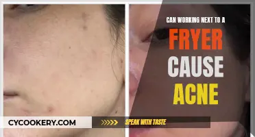 Facial Grease: Frying Oil and Acne at Work