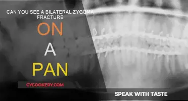 Zygoma Fracture: What a PAN Scan Can Show