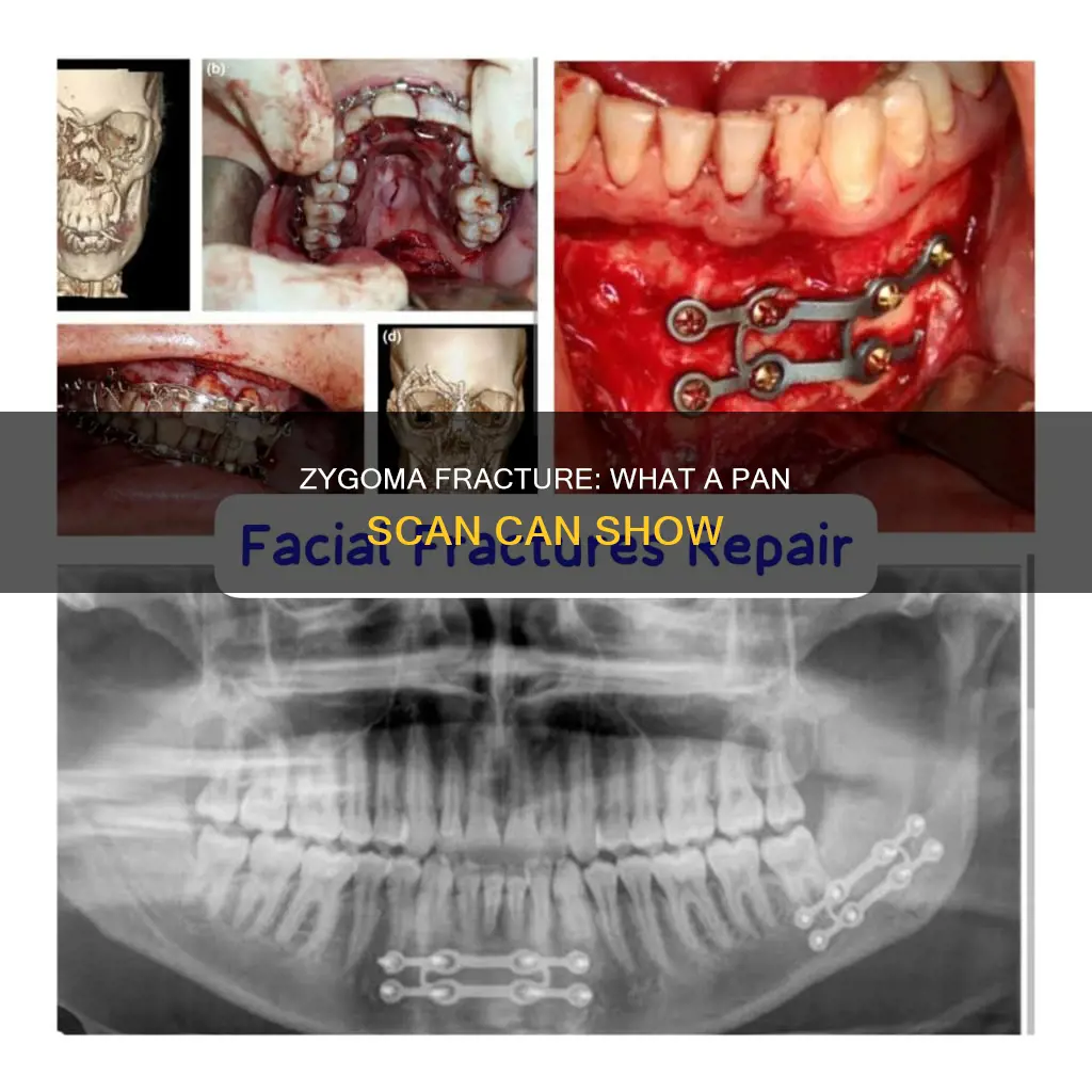 can you see a bilateral zygoma fracture on a pan