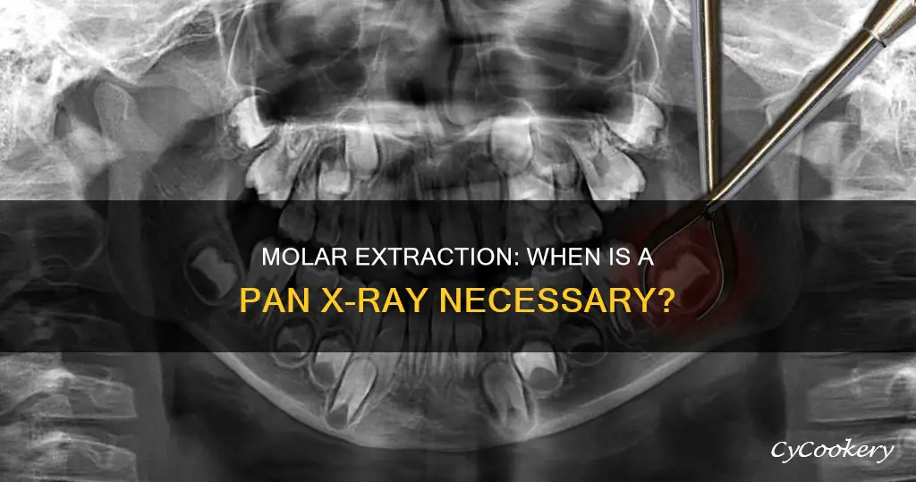 does every molar extraction get a pan x-ray