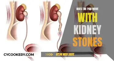 How Kidney Stones Move in the Body
