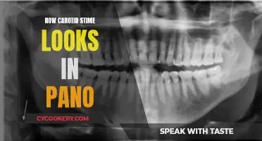Carotid Stime: What Your Pano Can Reveal