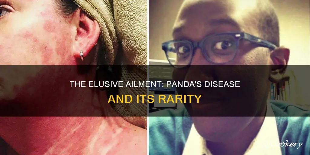 how rare is pandas disease