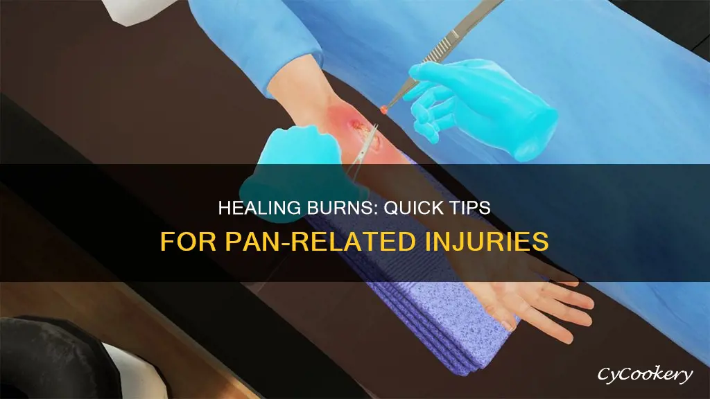 how to heal a burn from a pan