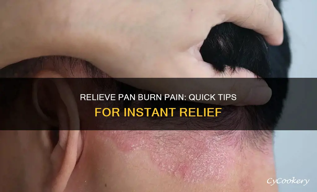 how to stop a pan burn from hurting