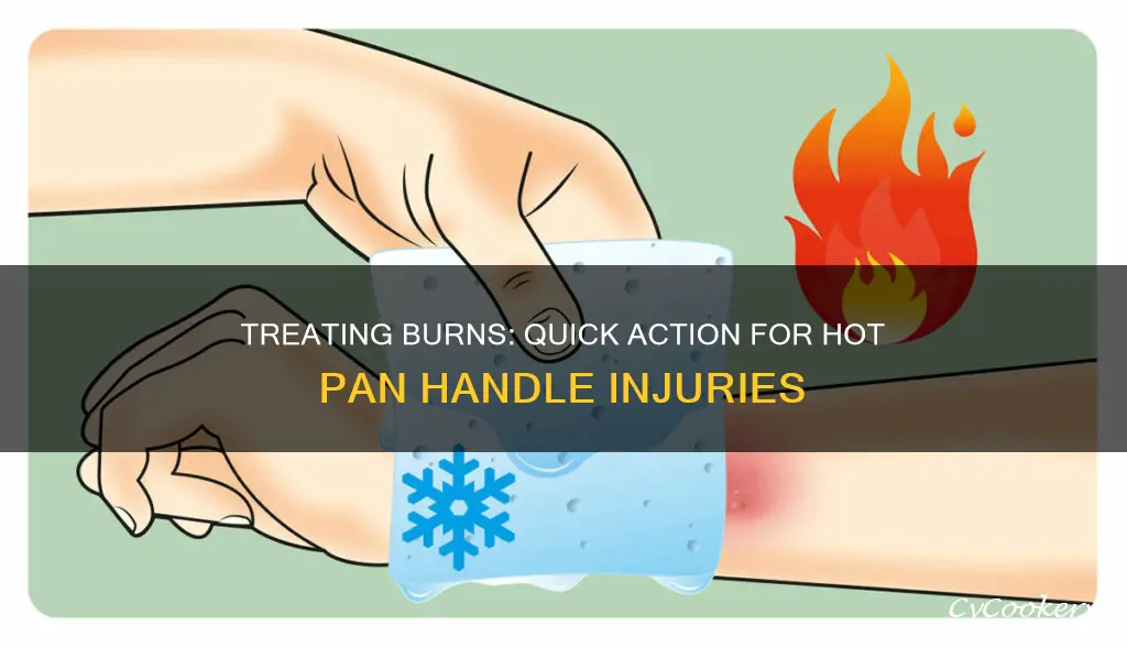 how to treat a burn from a hot pan handle