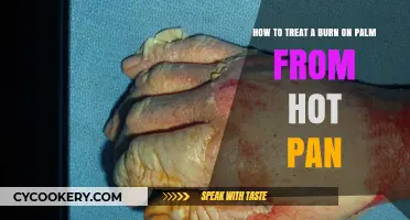 Treating Burns: Quick Action for Palm Injuries