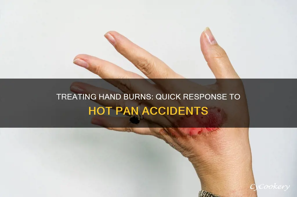 how to treat burn on hand from hot pan