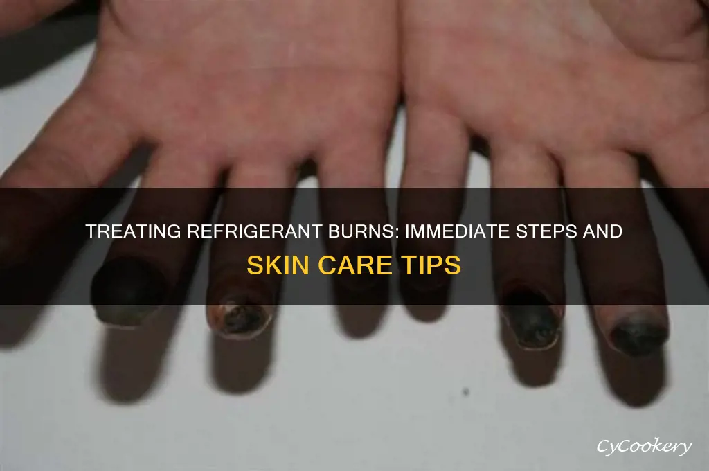 how to treat refrigerant burn on skin