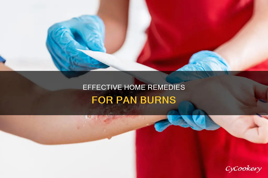 what helps with burns from a pan
