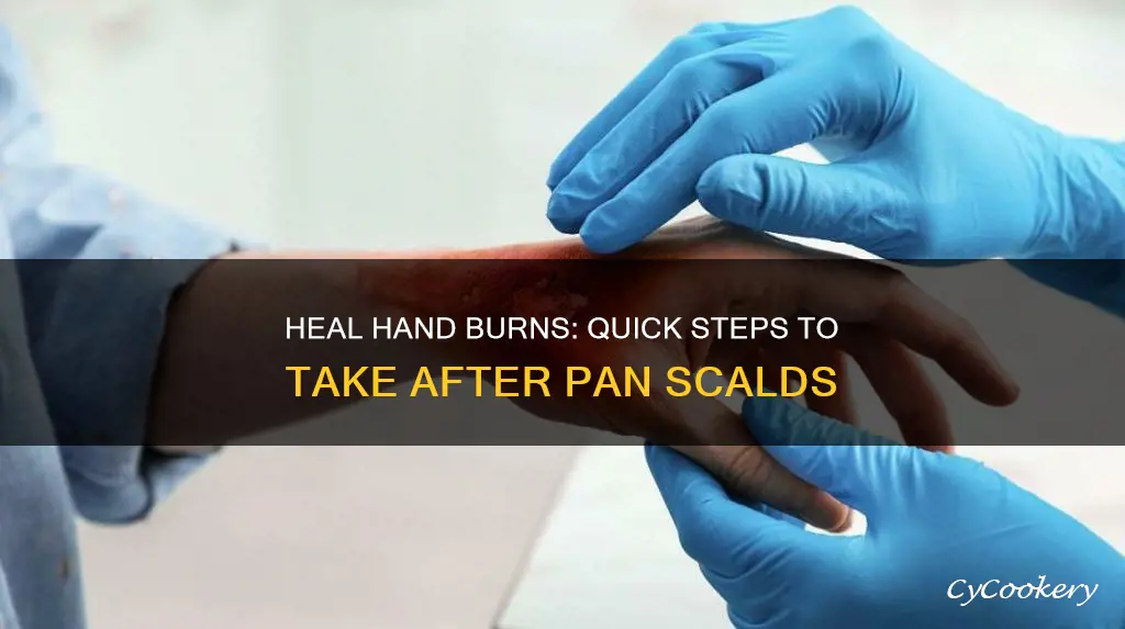 what to do after burning hand on pan