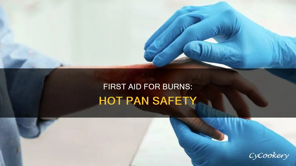 what to do if you get burned by hot pan