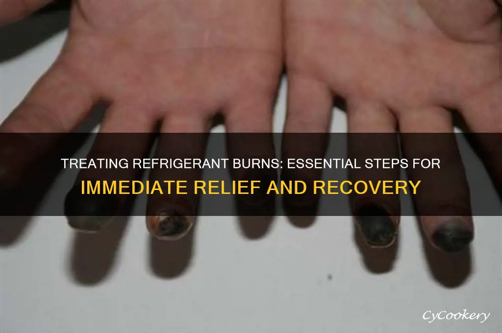 what to do to treat refrigerant burn